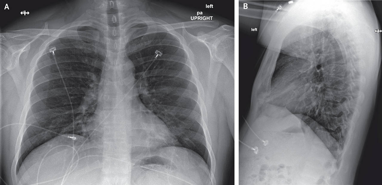 Posteroanterior and Lateral Chest Radiographs, Jan. 22, 2020 (Illness Day 7, Hospital Day 3). No acute intrathoracic plain-film abnormality was noted. (Snohomish Health District)