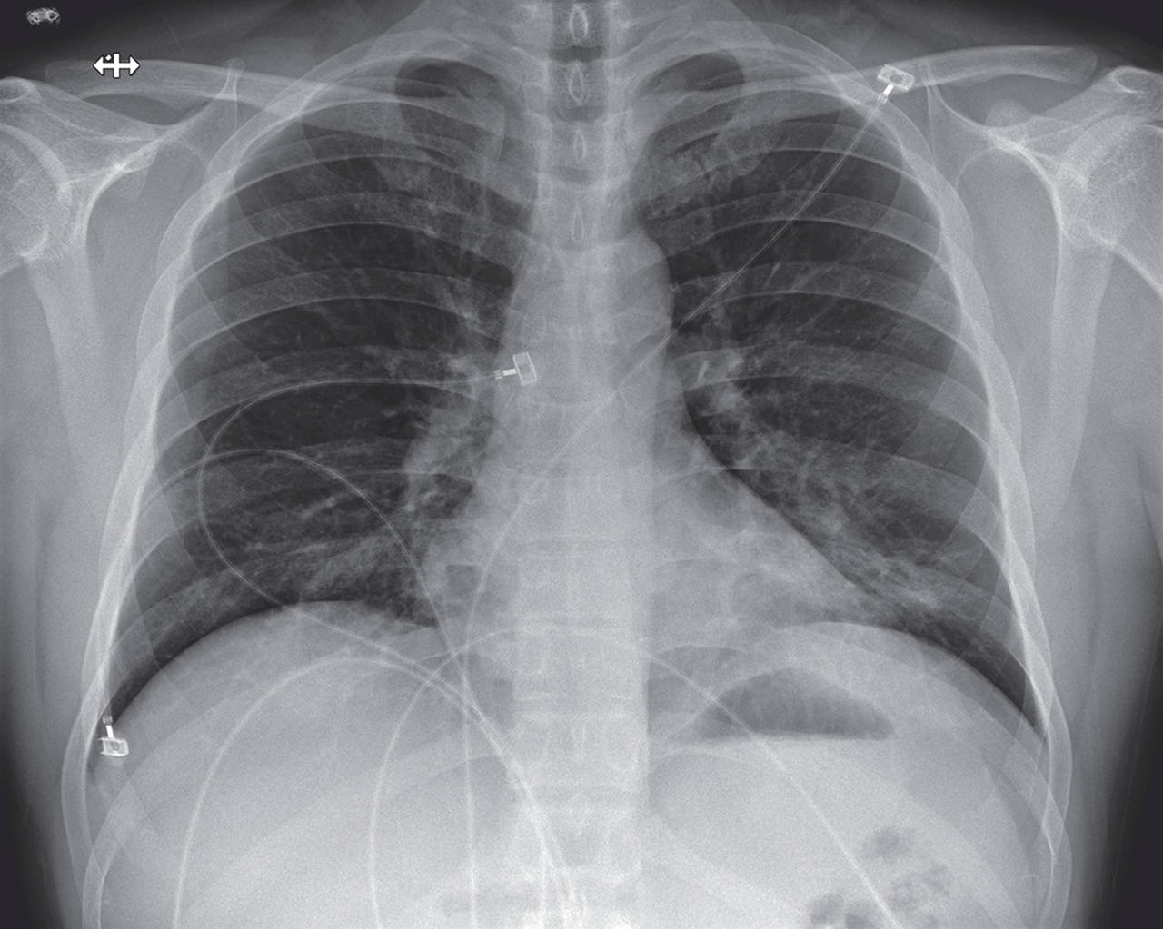 Posteroanterior Chest Radiograph, Jan. 24, 2020 (Illness Day 9, Hospital Day 5). Increasing left basilar opacity was visible, arousing concern about pneumonia. (Snohomish Health District)