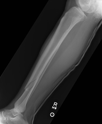 Seattle Police say a man called 911 Friday afternoon after finding what