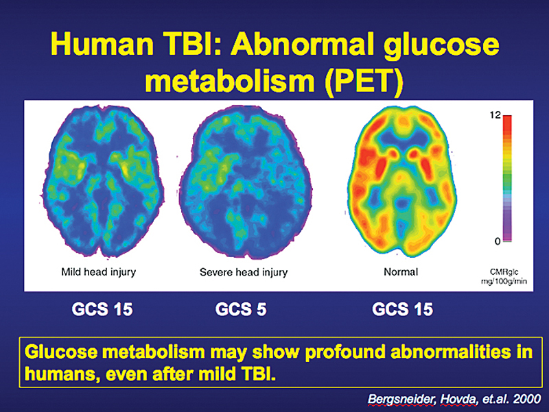 A breakthrough study at UCLA shows that a mildly concussed brain (left) and a traumatic brain injury (middle) experience similar shutdowns in energy generation. The scan at the far right shows a brain during normal function.