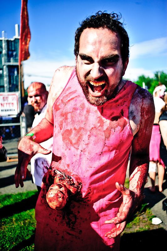 When the unformed twin is allowed to continue growing...