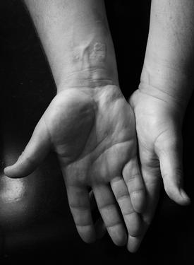 One of many grease burns