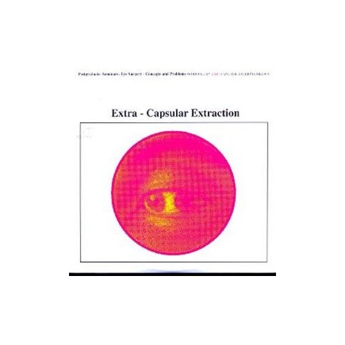 Extra-Capsular Extraction, Earth, Oct. 18, 1991