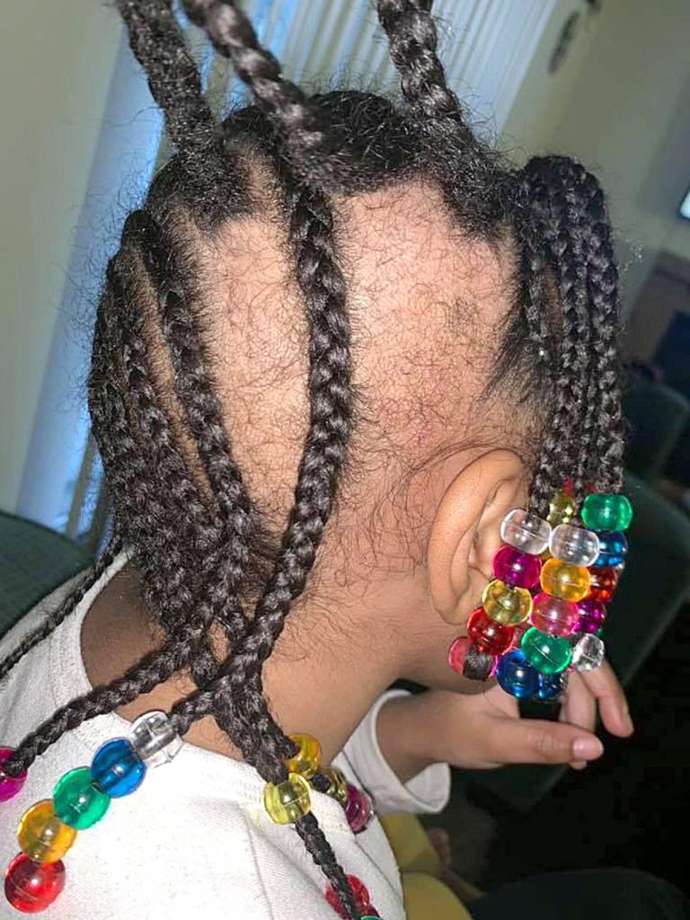 Federal Way mother Chelsy Cooper said her 2-year-old daughters hair was pulled out of her scalp (pictured) while she was at daycare. Police and Child Protective Services are investigating. Photo courtesy of Chelsy Coopers Facebook page