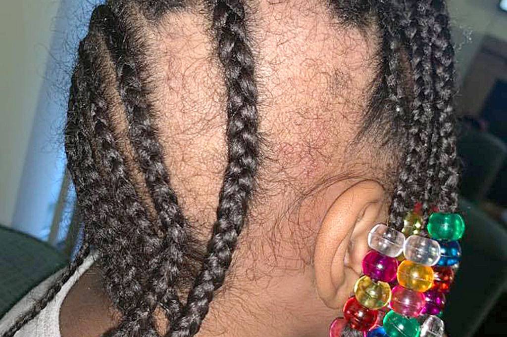 Police investigating mother’s claims that toddler’s hair was pulled from scalp at Federal Way daycare