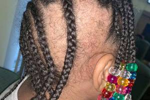 Police investigating mother’s claims that toddler’s hair was pulled from scalp at Federal Way daycare