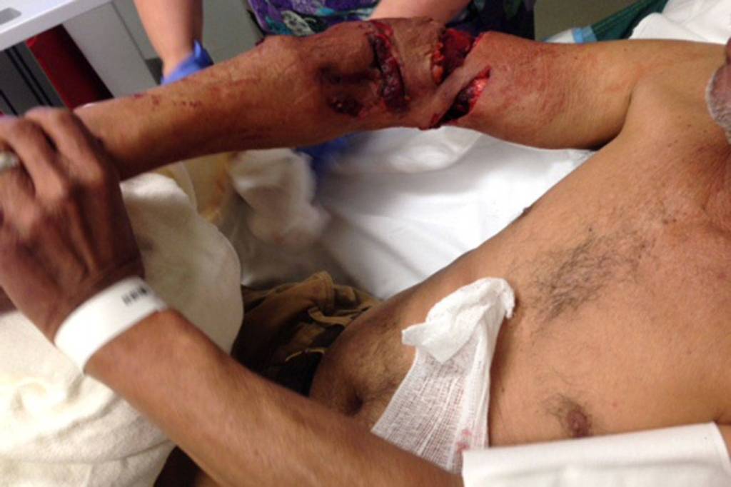 An image of Urbano Velazquezs arm after he was bitten by a King County Sheriffs Office K-9. It has been cropped to remove Velazquezs face. Photo obtained through a records request from King County Sheriffs Office.